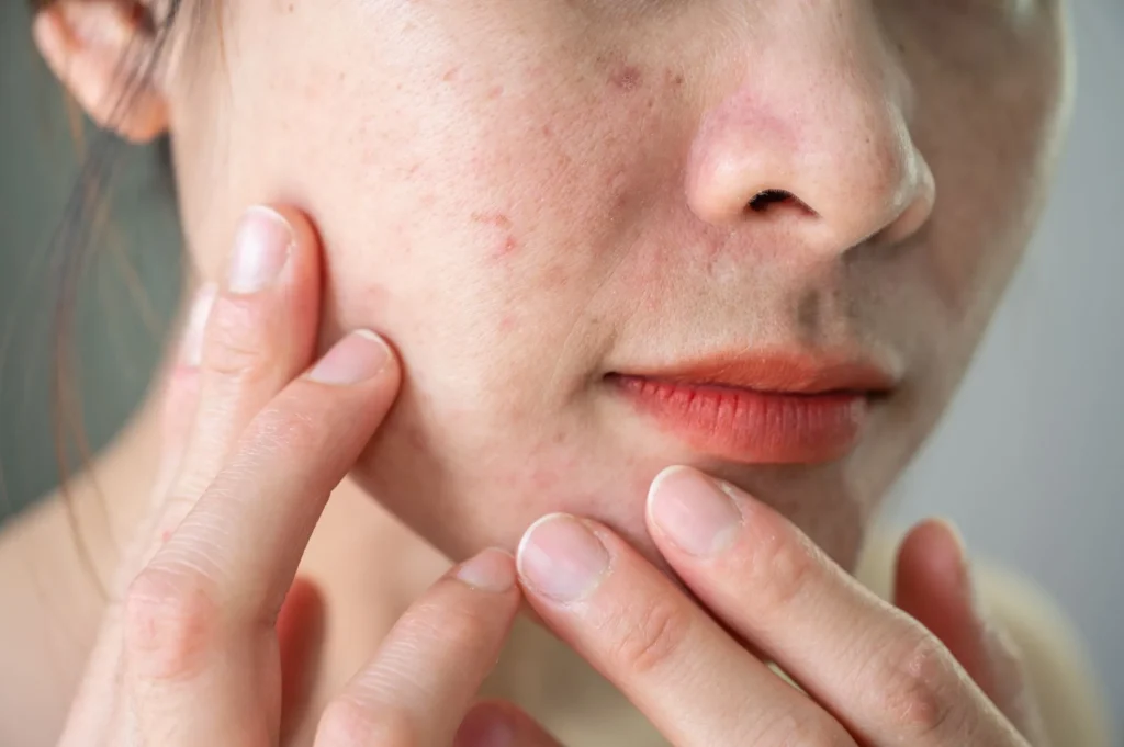 tratamiento rosacea