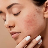 tratamiento acne sevilla