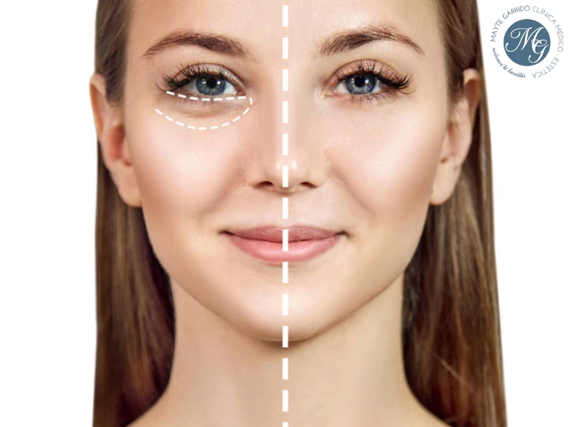 me he puesto ácido hialurónico y no se nota